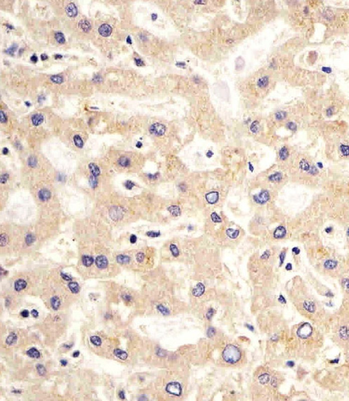 Figure 3:  Staining of PDK2 antibody (10-6544) in human liver sections by Immunohistochemistry (IHC-P - paraformaldehyde-fixed,  paraffin-embedded sections). Tissue was fixed with formaldehyde and blocked with 3% BSA for 0. 5 hour at room temperature; antigen retrieval was by heat mediation with a citrate buffer (pH6). Samples were incubated with primary antibody (1/25) for 1 hours at 37°C. A undiluted biotinylated goat polyvalent antibody was used as the secondary antibody.