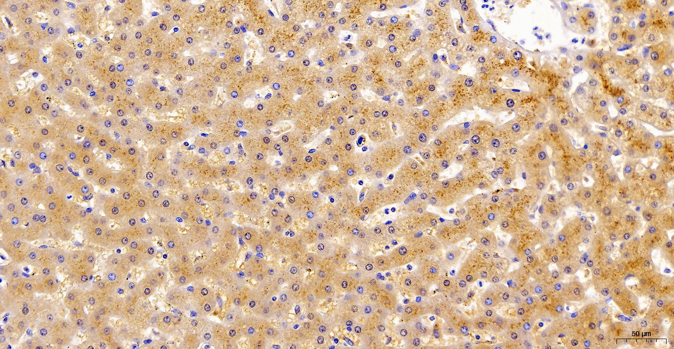 Figure-6 : Immunohistochemical analysis of Trim29 in Hepatocellular carcinoma tissue (20X) using Trim29 antibody (Clone: ABM43D2).