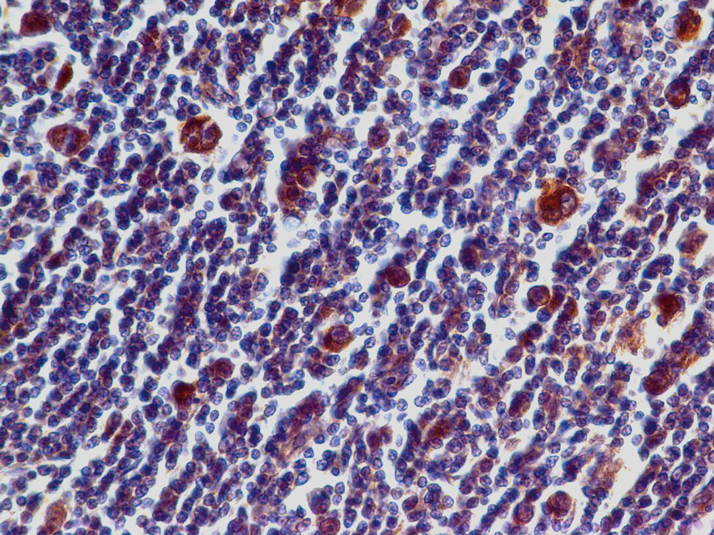 Fig-5: Immunohistochemical analysis of PD-L1 in Hodkin's Lymphoma tissue using PD-L1 antibody (Clone: ABM5F25) at 5 µg/ml.