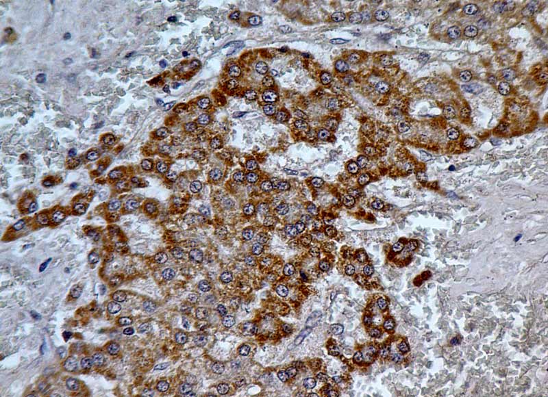 Figure-1: Immunohistochemical analysis of PDL2 in Hepatocellular carcinoma tissue using PDL2 antibody (Clone: ABM3D6.1G2) at 5 µg/ml.