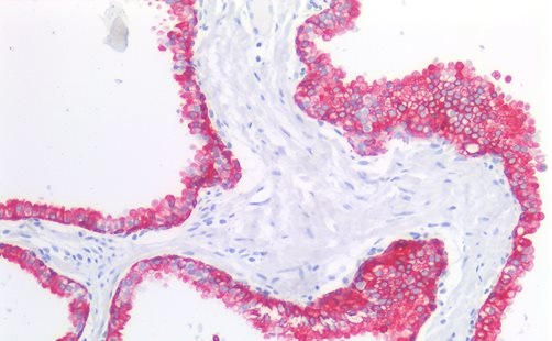 Figure-1: Immunohistochemistry staining of human prostate (paraffin sections) using anti-cytokeratin 19 (A53-B/A2).