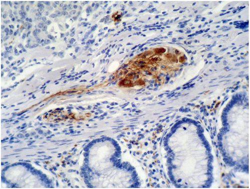 Figure 1 : Immunohistochemistry staining of colon carcinoma (paraffin-embedded sections) with anti-p21 (WA-1).