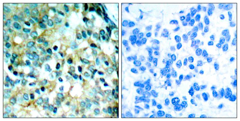 Figure 2: Immunohistochemical analysis of paraffin- embedded human breast carcinoma tissue using Src (phospho- Tyr418) antibody (35-1089 ).