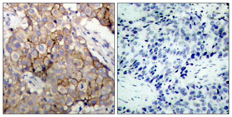 Figure 2: Immunohistochemical analysis of paraffin-embedded human breast carcinoma tissue using EGFR(Ab-1092) Antibody 35-1428 (left) or the same antibody preincubated with blocking peptide(right).
