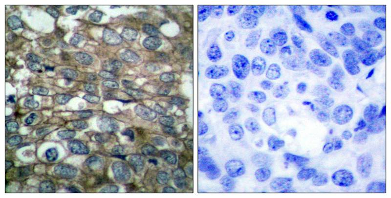 Figure 2: Immunohistochemical analysis of paraffin-embedded human breast carcinoma tissue using EGFR(Ab-869) Antibody 35-1560 (left) or the same antibody preincubated with blocking peptide(right).