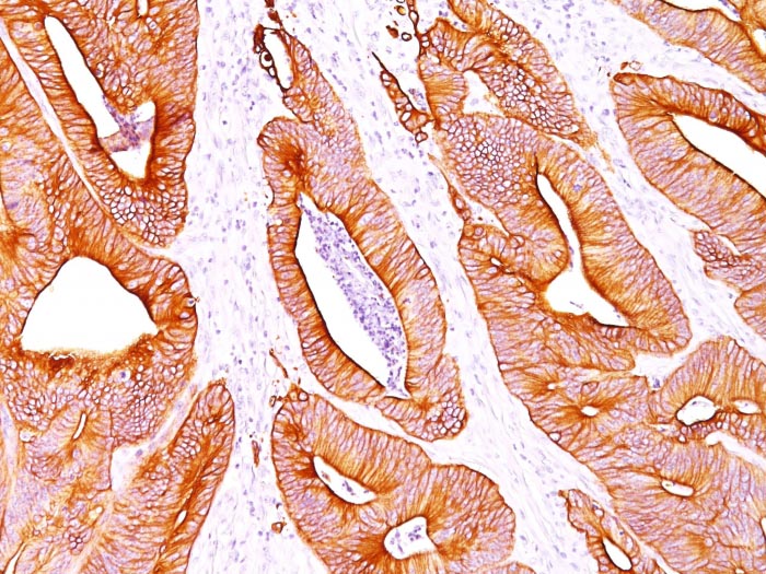 Monoclonal Antibody to Cytokeratin, pan (Epithelial Marker)(Clone : AE-1/AE-3)  Monoclonal Antibody to Cytokeratin, pan (Epithelial Marker)(Clone : AE-1/AE-3)