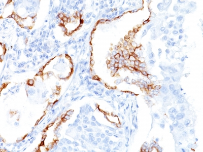 Formalin-fixed, paraffin-embedded human Lung SCC stained with Cytokeratin 7 Monoclonal Antibody (K72.7)