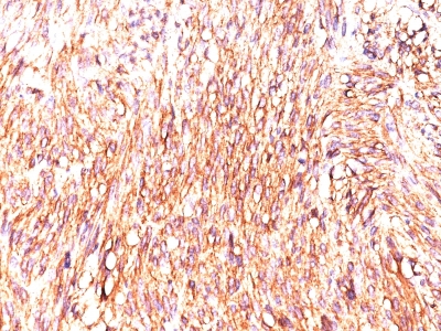 Monoclonal Antibody to DOG-1 / TMEM16A / ANO1 (Gastrointestinal Stromal Tumor Marker)(Clone : DOG-1.1)
