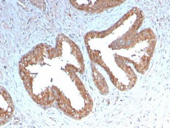 Fig. 1: Formalin-fixed, paraffin-embedded human Prostate Carcinoma stained with COX-2 Recombinant Rabbit Monoclonal Antibody (COX2/3232R).