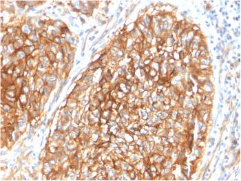 Fig. 3: Formalin-fixed, paraffin-embedded human Lung Carcinoma stained with CD9 Mouse Monoclonal Antibody (CD9/1619).