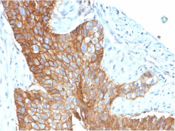 Fig. 4: Formalin-fixed, paraffin-embedded human Cervical Carcinoma stained with CD9 Mouse Monoclonal Antibody (CD9/1619).