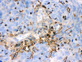 Figure 6: Anti-beta-Actin antibody(monoclonal)39-1062. IHC(P): Human Lung Cancer Tissue.