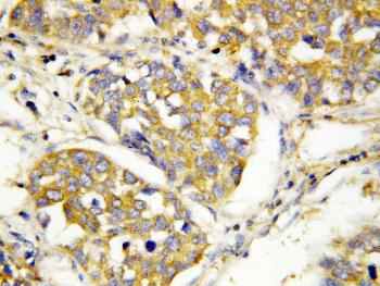 Figure 2: Anti-TLR4 antibody(39-2114). IHC(P): Human Lung Cancer Tissue.