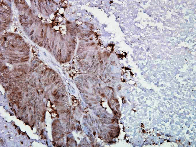 Figure1 : Mouse Anti-Hsp90 alpha Antibody [Hyb-K41009] used in Immunohistochemistry (IHC) on Human colon carcinoma
