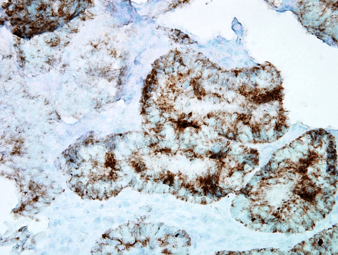 Figure 2 :  Mouse Anti-Hsp60 Antibody [LK-1] used in Immunohistochemistry (IHC) on Human colon carcinoma