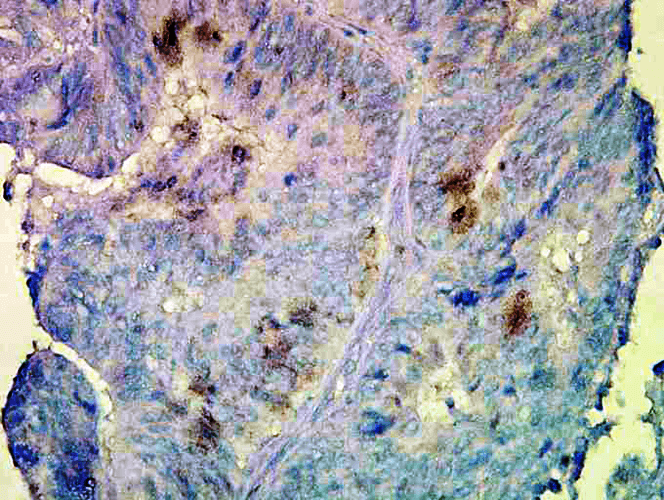 Figure 2 :  Mouse Anti-Hsp90 beta Antibody [Hyb-K3701] used in Immunohistochemistry (IHC) on Human colon carcinoma