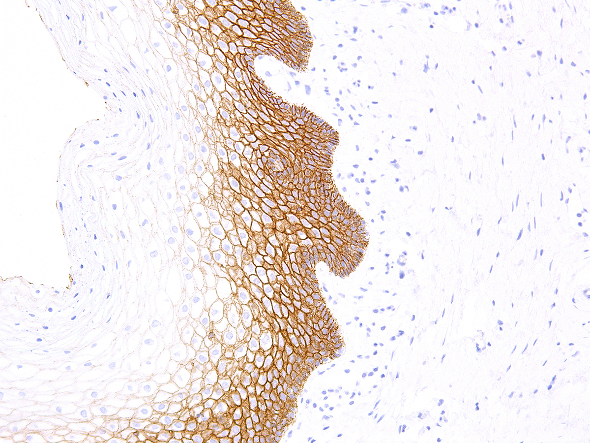 Figure 2: Immunohistochemical analysis of E-cadherin (Clone: IHC564) on Breast - 20X