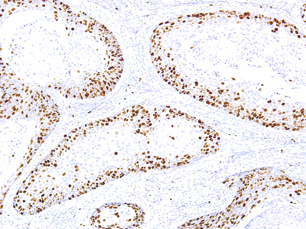 Figure 1: Immunohistochemical analysis of Ki-67 (Clone: IHC067) on Cervical Cancer - 10X