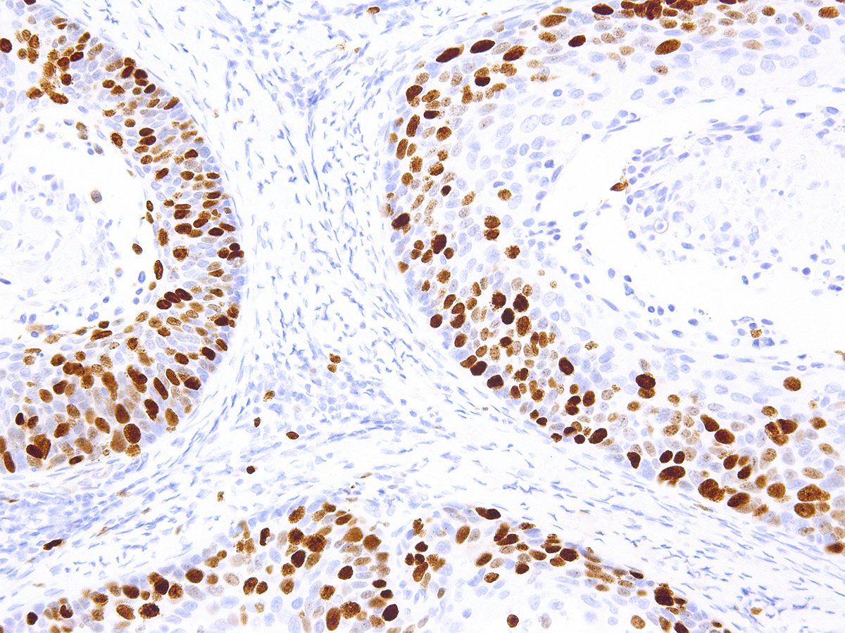 Figure 2: Immunohistochemical analysis of Ki-67 (Clone: IHC067) on Cervical Cancer - 20X