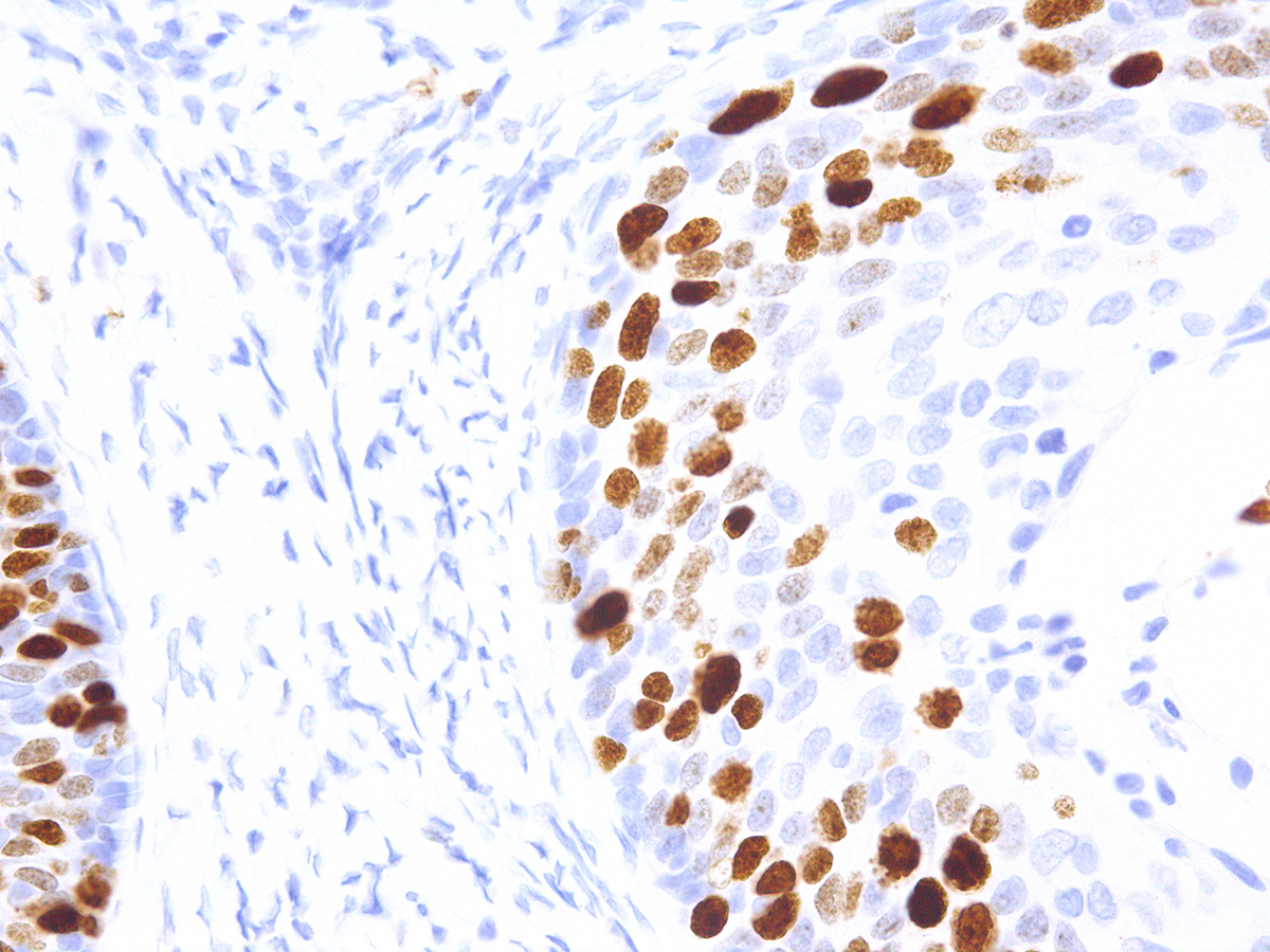 Figure 3: Immunohistochemical analysis of Ki-67 (Clone: IHC067) on Cervical Cancer - 40X